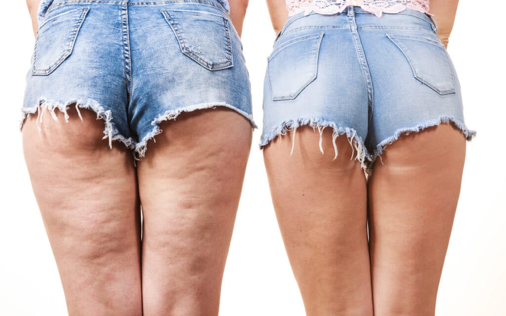 Can I Get Laser Lipo to Remove Cellulite?